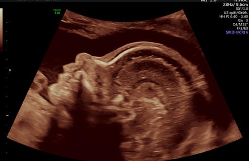 fetales Profil 22. SSW im Ultraschall