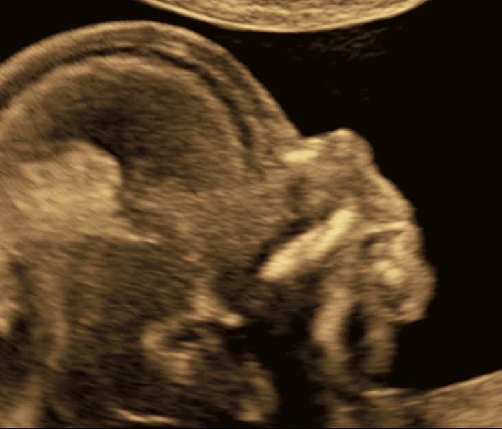 Profil in der 14. SSW