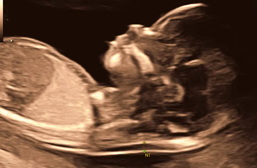 Profil in der 22. SSW