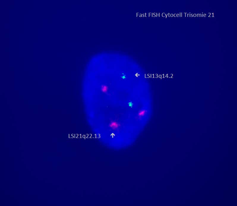 FISH-Scnelltest bei Trisomie 21