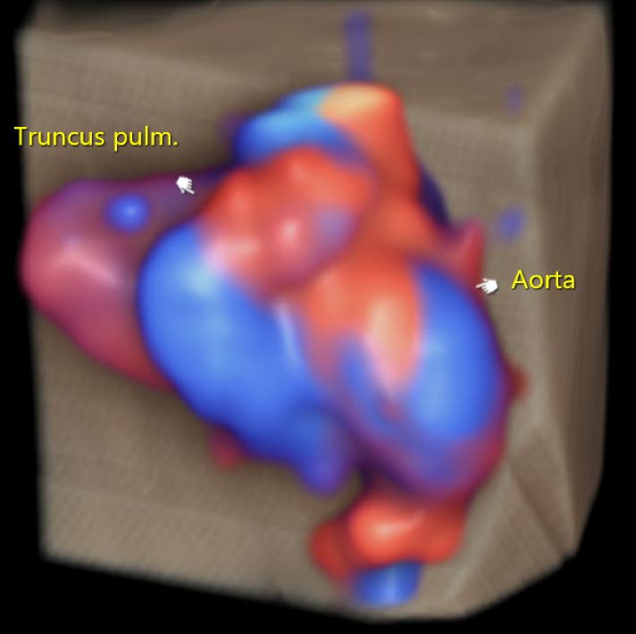 Herz im 3D/4D-Farbdoppler