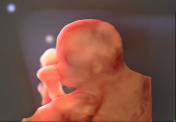 Fetus 13. SSW