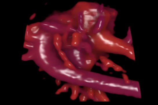 fetaler Aortenbogen in der 3D Rekonstruktion